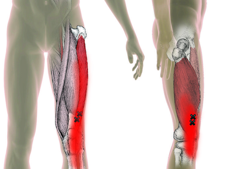 one of the important cause of pain in knee osteoarthritis